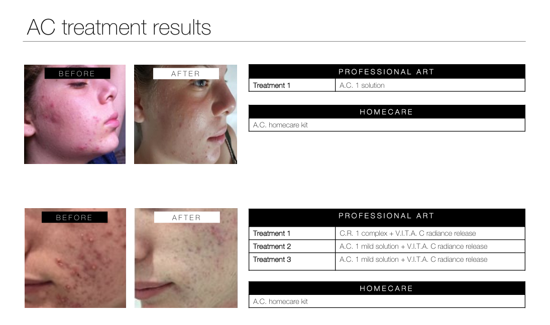 phformula acne treatment results durbanville