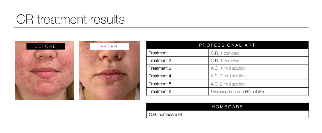 rosacea skin resurfacing results durbanville