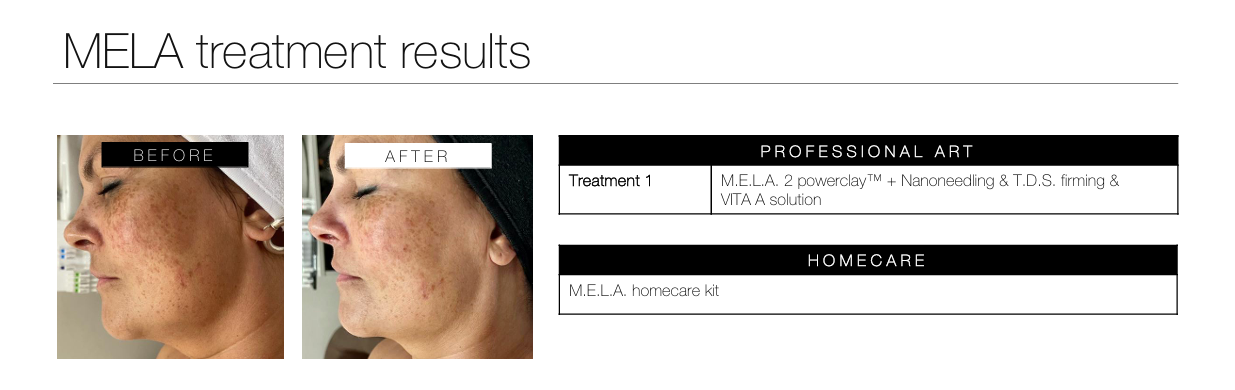 skin resurfacing pigmentation results serayu beauty